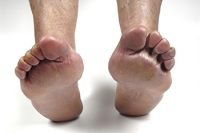 Rheumatoid Arthritis and Foot Swelling